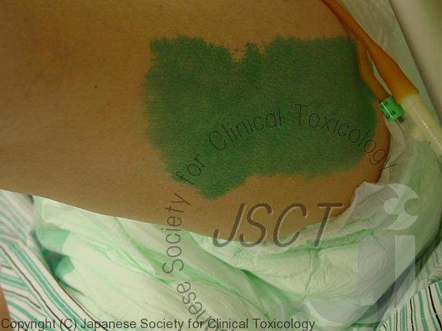 그라목손에 노출된 환자의 피부